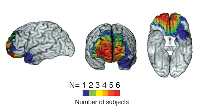 Brain scan showing damage to the frontal cortex